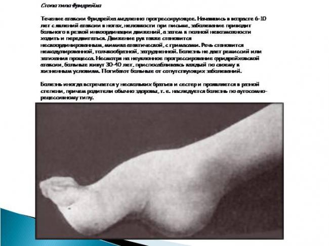 Атаксия фридрейха: чем непохожа она на прочие атаксии
