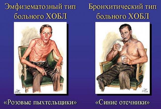 Деформирующий бронхит симптомы и лечение