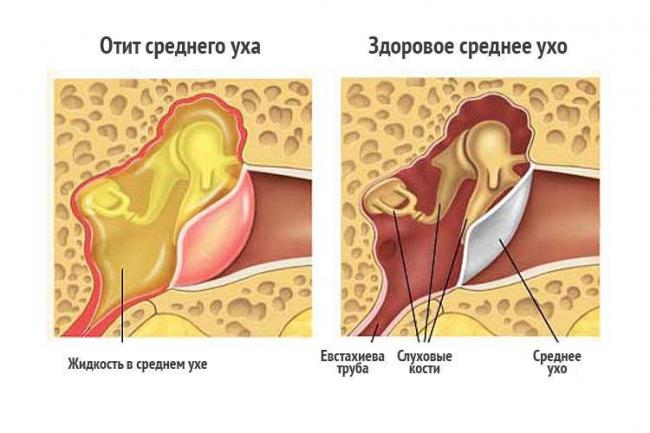 Как снять боль в ухе при простуде