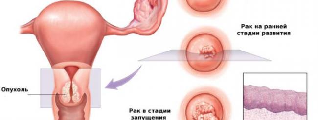 Фоновые и предраковые заболевания шейки матки