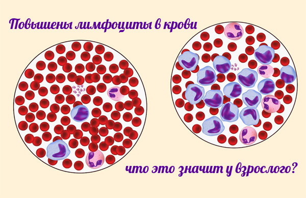 Лимфоцитоз