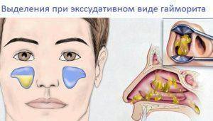 Сфеноидит: симптомы и лечение