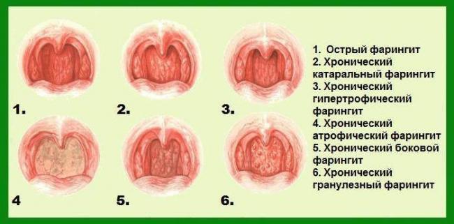 Фарингит у взрослых — что это, симптомы и лечение, фото, первые признаки при фарингите