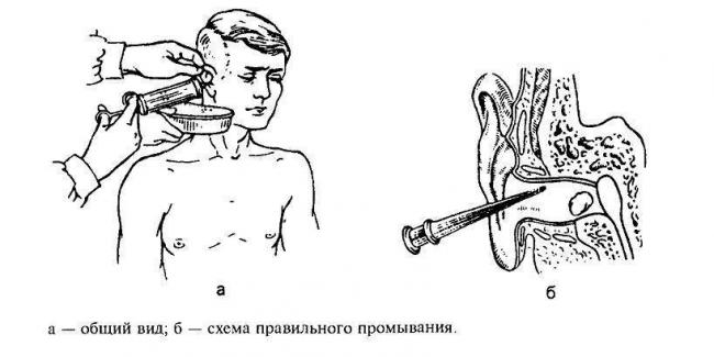 Боль в ушах при простуде: возможные причины и методы лечения