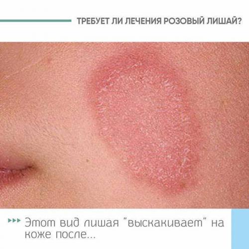 Как быстро избавиться от грибка малассезии?
