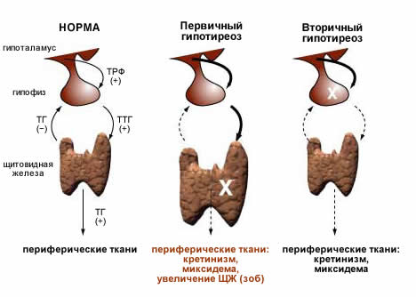Симптомы и лечение микседемы