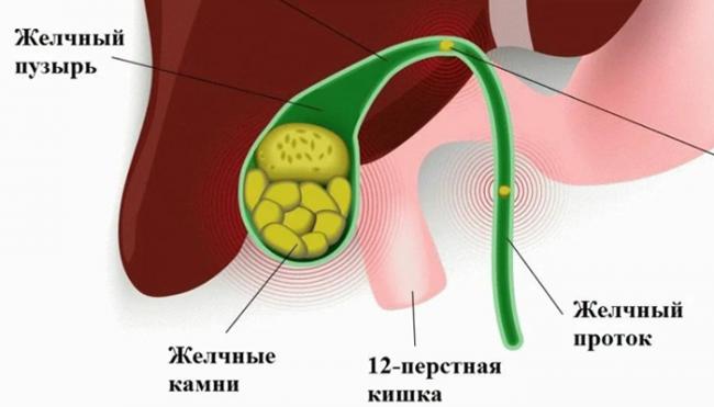 Питание при камнях в поджелудочной железе