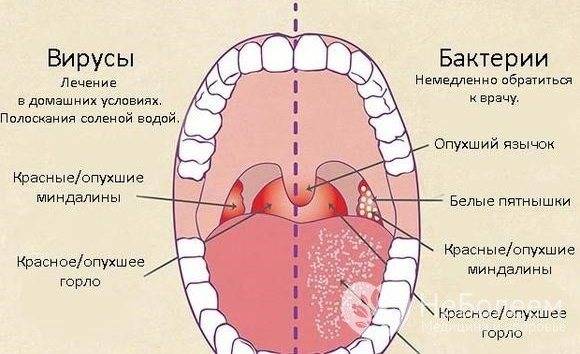 Когда фарингит где болит
