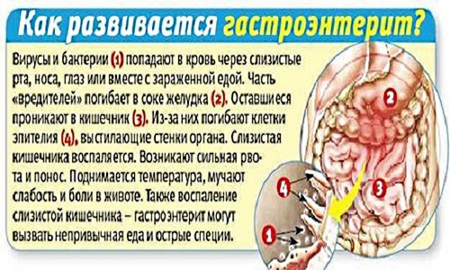 Причины, симптомы, лечение острого гастроэнтерита