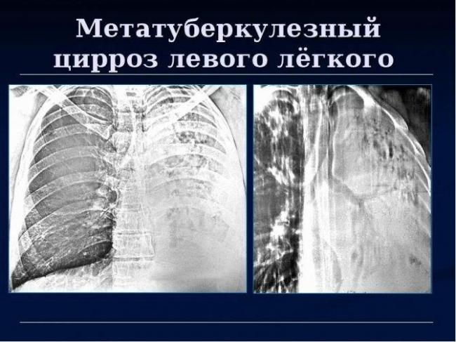 Метатуберкулезные изменения могут привести к повторному развитию туберкулеза