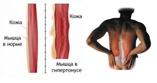 Что выбрать: мидокалм или калмирекс?