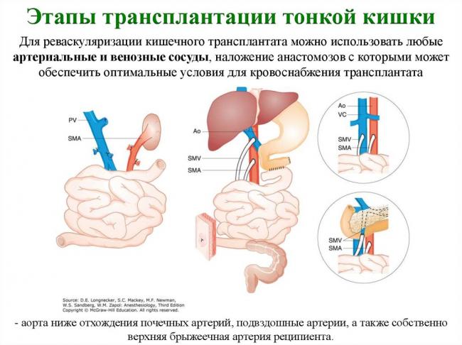 Резекция кишечника, операция по удалению кишки: показания, ход, реабилитация