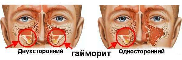 Антибиотик при гайморите взрослым название препаратов