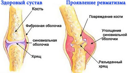 Ревматическая лихорадка. причины, симптомы, признаки, диагностика и лечение патологии