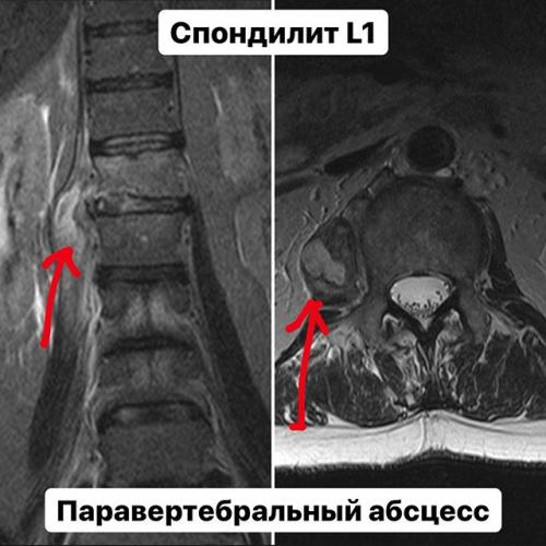Гнойный спондилит шейного отдела позвоночника