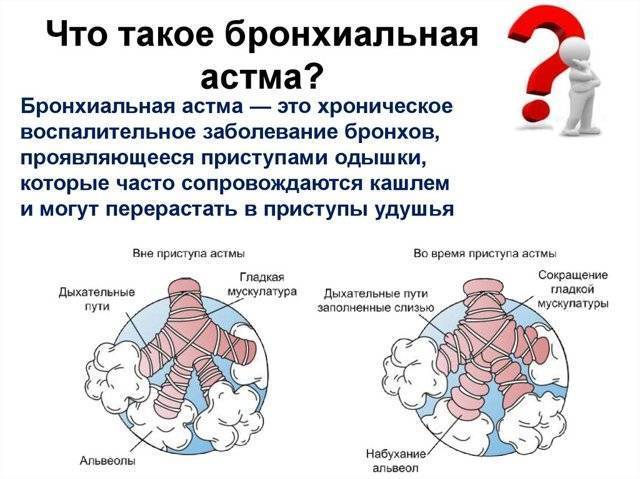 Кто лечит астму пульмонолог или аллерголог