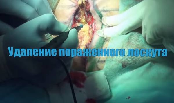 Киста копчика: симптомы и лечение у мужчин, как лечить без операции в домашних условиях