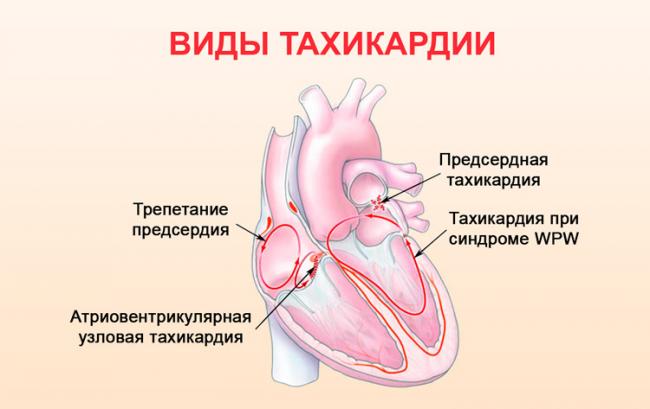 Мерцательная аритмия (фибрилляция предсердий) | симптомы | диагностика | лечение - docdoc.ru
