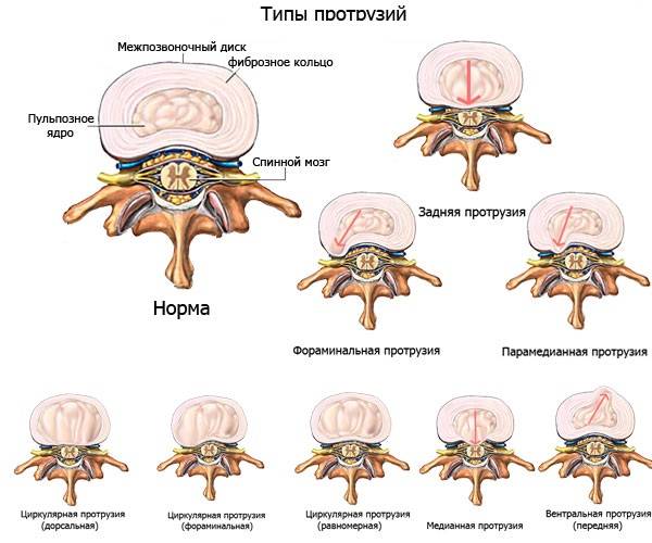 Причины, симптомы и методы лечения протрузии межпозвоночных дисков шейного отдела