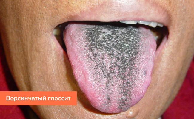 Симптомы, причины и лечение глоссита языка
