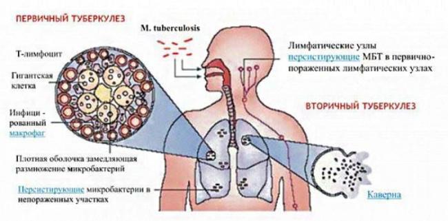 Открытая форма туберкулеза