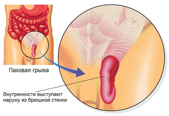 Паховая грыжа. причины, симптомы, диагностика и лечение