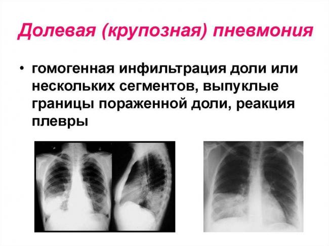 Особенности лечения и профилактика крупозной пневмонии