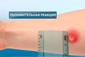 Что такое диаскинтест и противопоказания делать детям