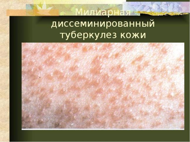 Туберкулез легких (милиарный): причины, признаки, профилактика — онлайн-диагностика