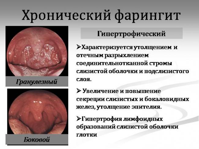 Сколько дней лечится гранулезный фарингит