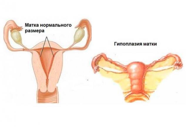 Что за странный диагноз — генитальный инфантилизм? недоразвитие половых органов (инфантилизм).