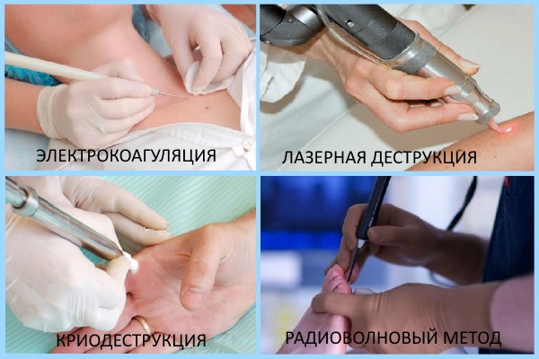 Бородавчатый невус фото