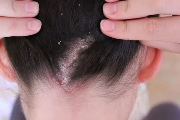 Чем лечить грибок на голове в домашних условиях, методы лечения