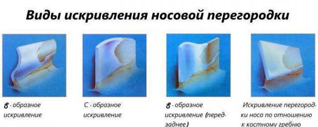 Смещенная носовая перегородка: симптомы, признаки, прогноз — онлайн-диагностика
