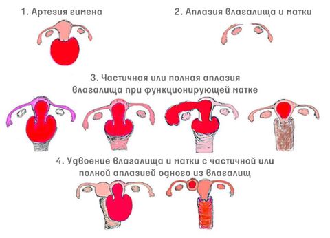 Что за странный диагноз — генитальный инфантилизм? недоразвитие половых органов (инфантилизм).