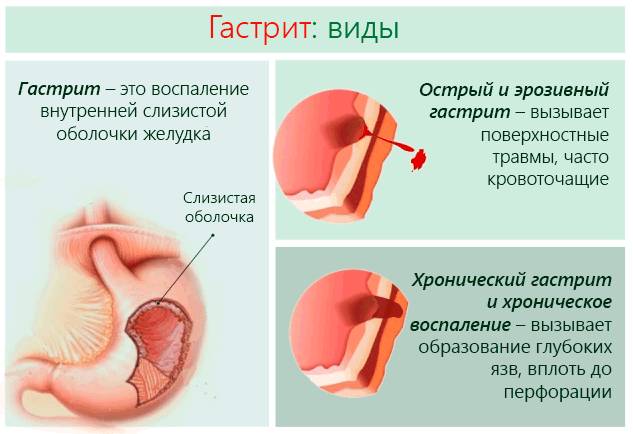 Правильная диета при гастрите с повышенной кислотностью, меню на каждый день с рецептами