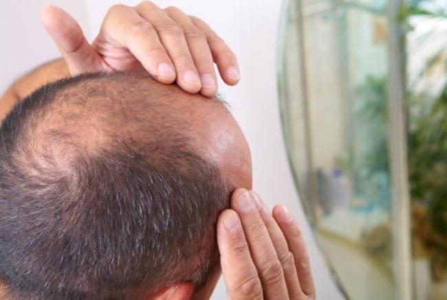 Очаговая алопеция: признаки и методы борьбы