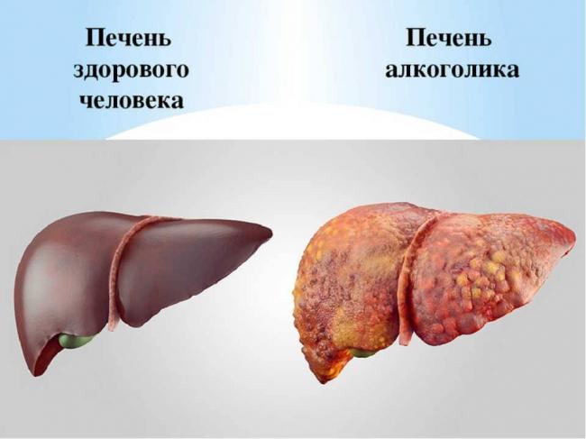 Что происходит с печенью при употреблении алкоголя?