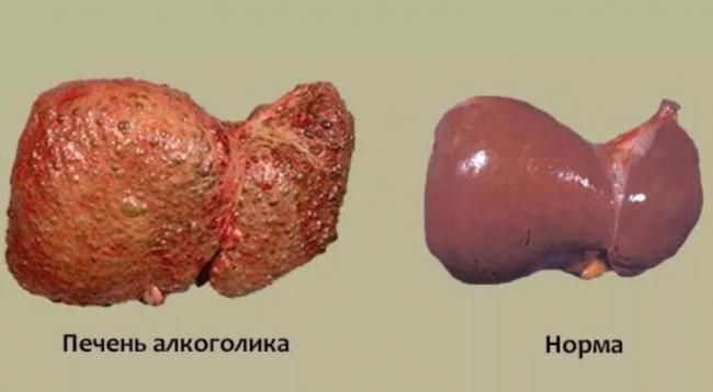Что происходит с печенью при употреблении алкоголя?