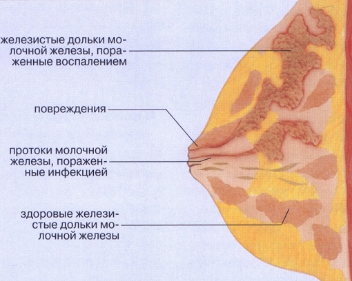 Лактостаз у кормящей матери: причины, симптомы и лечение