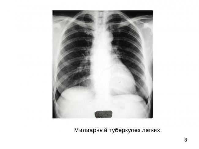 Острый милиарный туберкулез легких