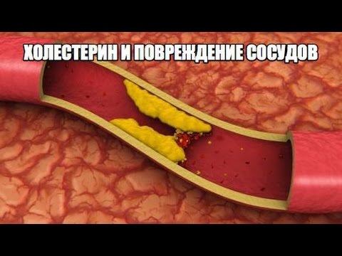 Как действует двухфазный концентрат holestop (холестоп) при холестерине, отзывы пациентов и врачей