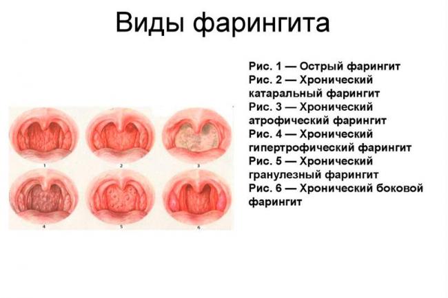 Симптомы и лечения острого хронического фарингита у взрослых