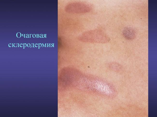 Склеродермия. причины, симптомы и признаки, диагностика и лечение болезни