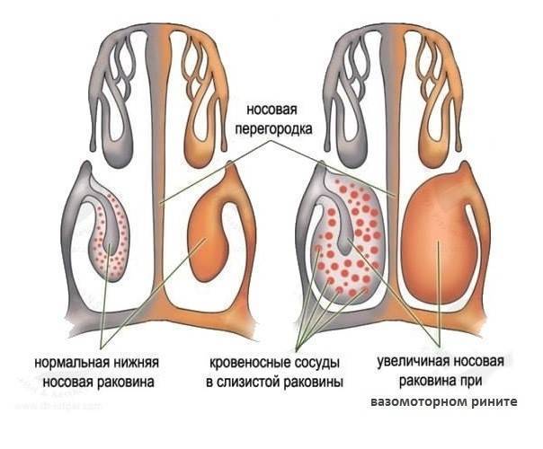 Соплей нет, а нос заложен у ребенка: как и чем лечить, что делать