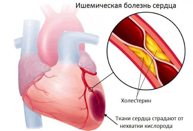 Аритмия сердца симптомы лечение первая помощь
