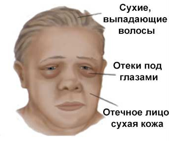 Симптомы и причины микседемы