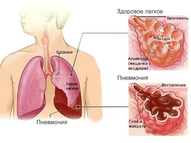 Пневмония без температуры у ребенка