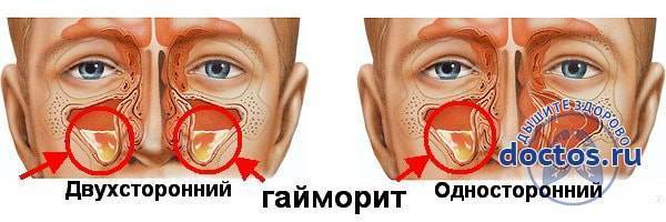 Признаки гайморита у взрослых как лечить дома
