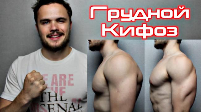 Лфк при кифозе грудного отдела позвоночника для детей